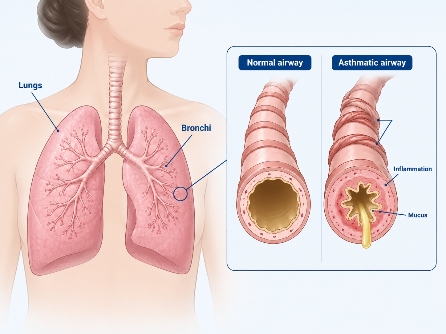 Asthma
